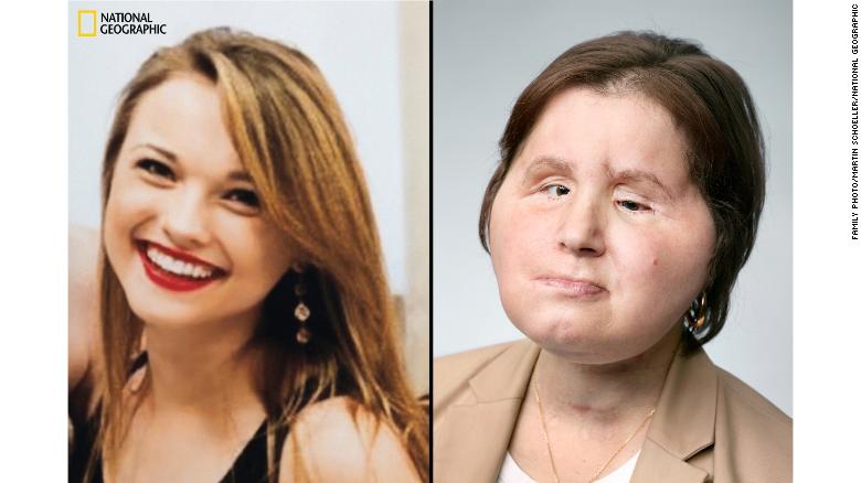 180810162525 02 face transplant katie stubblefield restricted exlarge 169